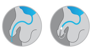 Get the Facts About Urethral Insert Devices for Men with Urinary Incontinence